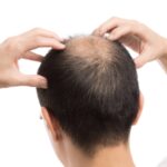 【後悔しない】薄毛の改善なら増毛よりAGA治療がおすすめ！5つの理由と根本的な解決方法を紹介